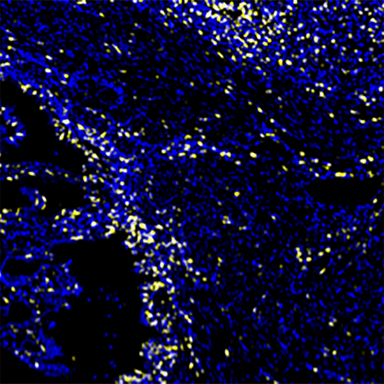 An ARID1A gene-deficient human endometrial tumor being infiltrated by CD8+ T cells (yellow). All cell nuclei are colored blue, including tumor cells and CD8+ T cells.
